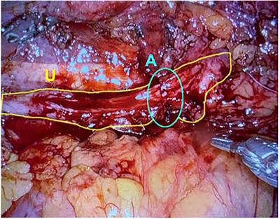 The role of bowel for minimally invasive treatment of stricture disease